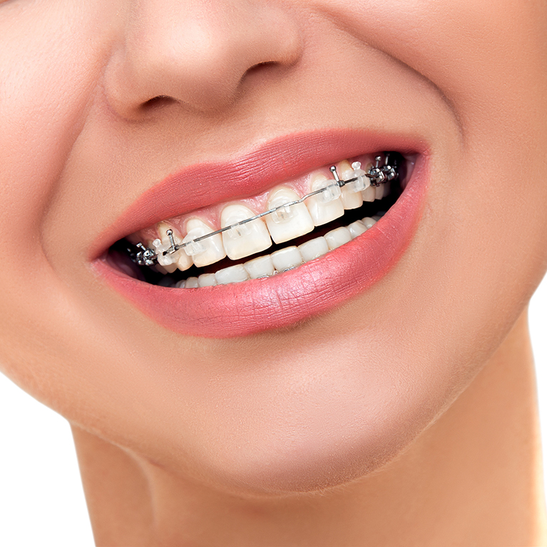 Damon Braces Treatment in Chennai