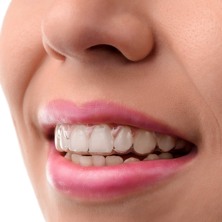 Clear aligners  Transparent Teeth Braces in Chennai